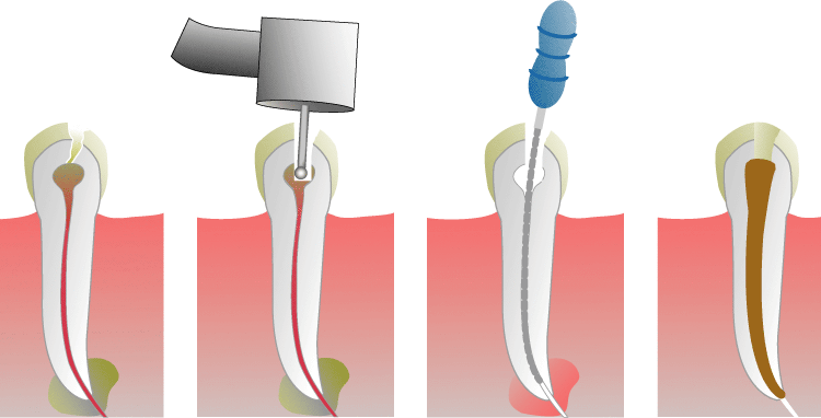 Root_Canal_Illustration-750x382 (1)