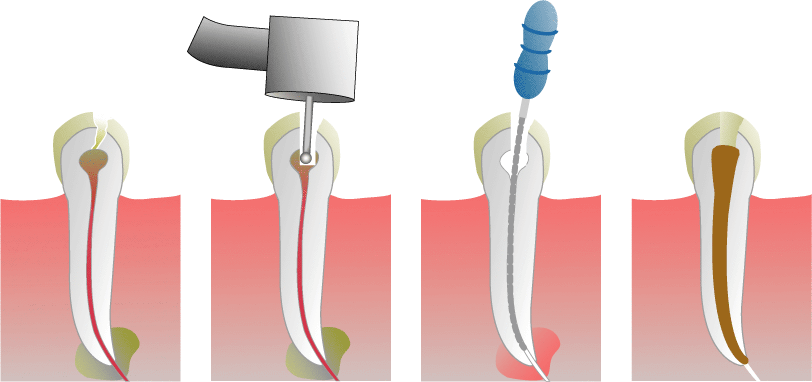 Root_Canal_Illustration