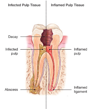 abscessed-tooth-1