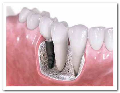 dental-implants23