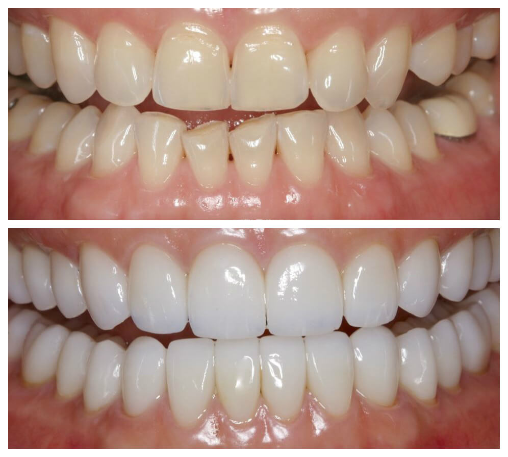 Before and after our full mouth reconstruction service