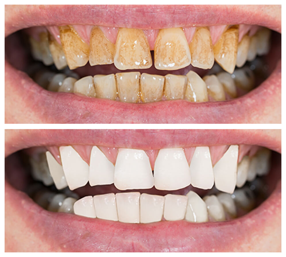 Before and after our full mouth reconstruction treatment