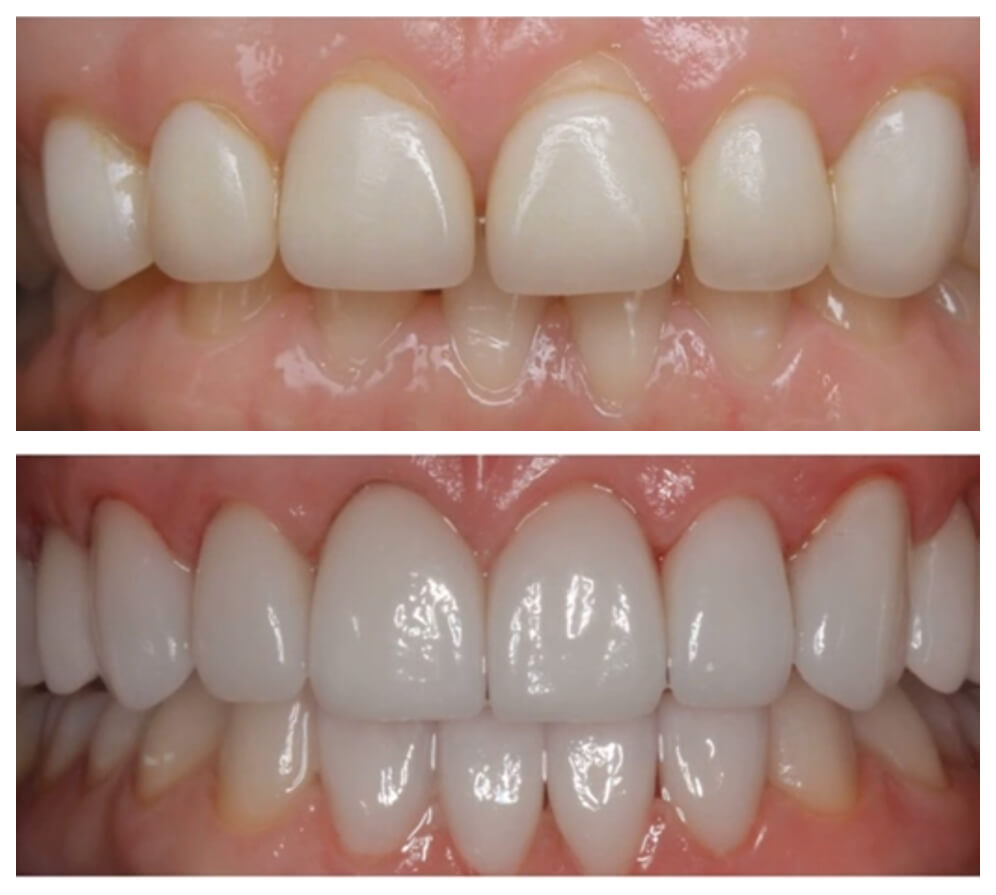 Before and after full mouth reconstruction treatment