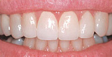 right-for-you-teeth-align-crooked-after