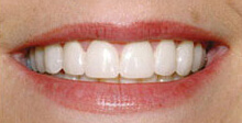right-for-you-teeth-hollywood-after (1)