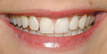right-for-you-teeth-hollywood-before-1 (1)