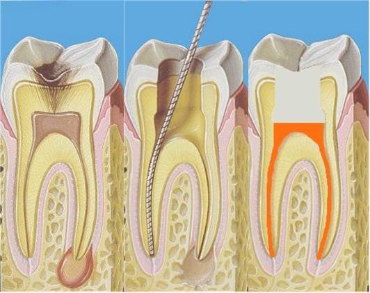 rootcanal-1