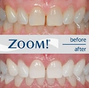Chair side whitening before and after 